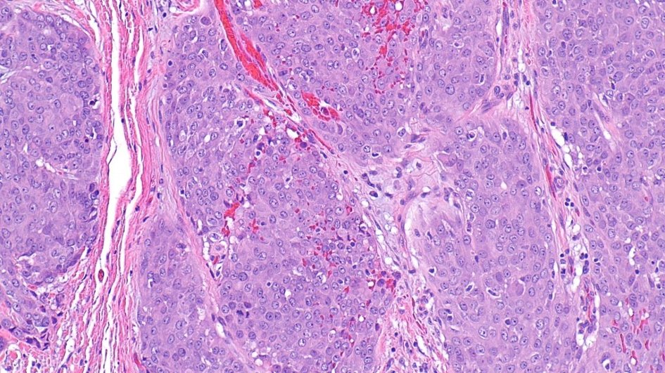 carcinoma of salivary gland