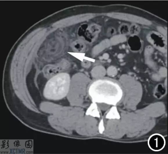 大网膜扭转(torsion of greater omentum)CT病例图片影像诊断分析