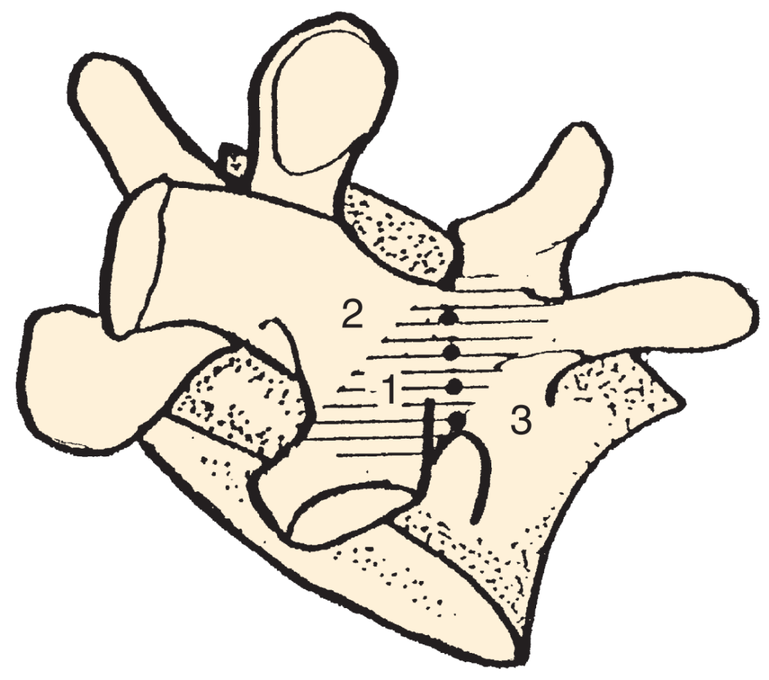 腰椎峡部解剖与峡部裂