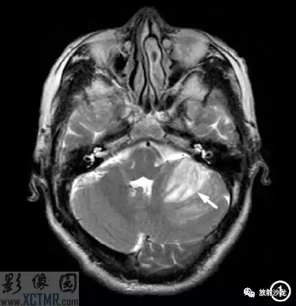 【每日一例 | 382期】左侧小脑半球病变MRI病例