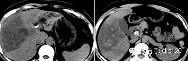 胆总管结石致肝内外胆管扩张及慢性炎症CT病例图片影像诊断分析