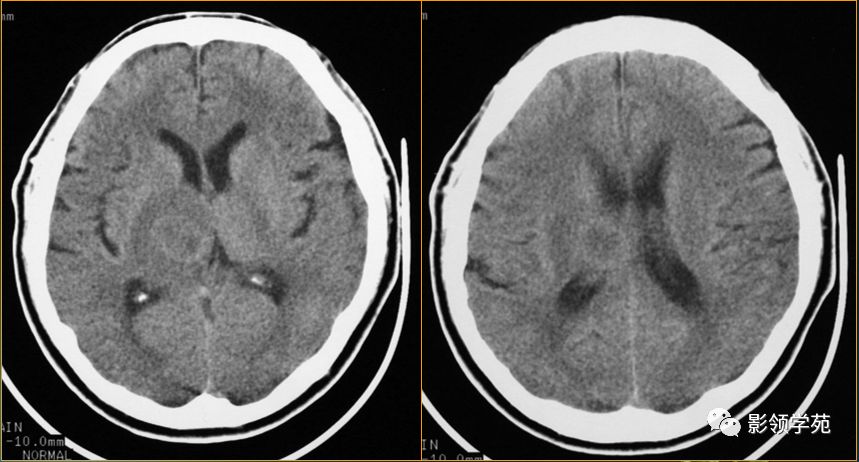 脑脓肿与脑结核的影像表现