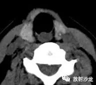 甲状腺钙化性病变的超声和CT联合诊断