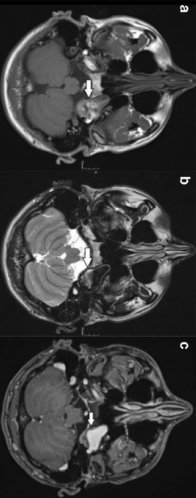 Neuroradiology：表现为舌下神经麻痹的动脉瘤
