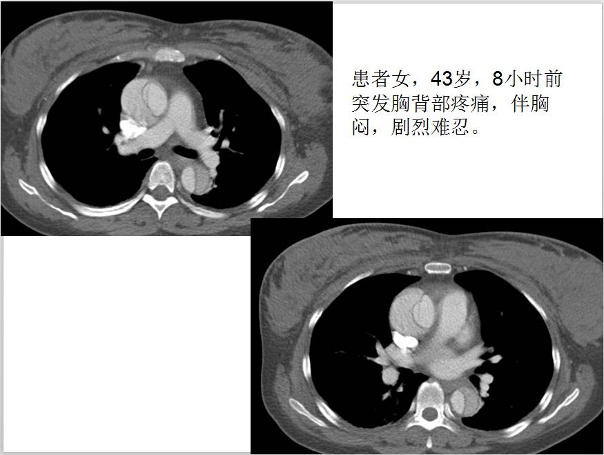 【CLEAR柯麗爾每日一例】妊娠合并主動(dòng)脈夾層