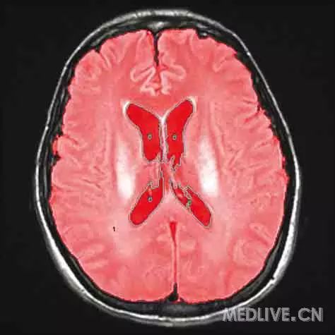 JAMA Neurol：难治性癫痫持续状态或可导致<font color="red">脑萎缩</font>