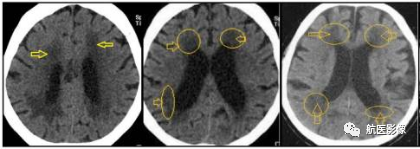 颅脑MR脑白质高信号是缺血灶吗？
