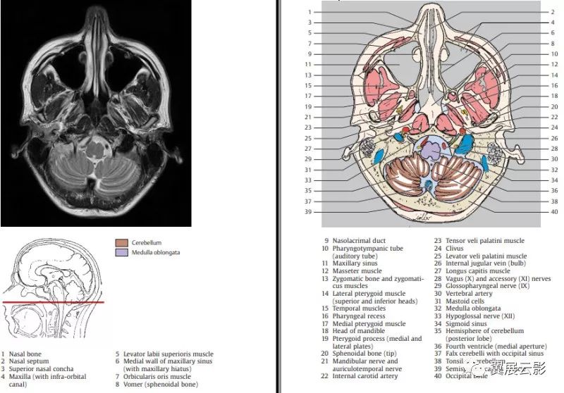 医学美图 || 颅脑MR-T2对照图谱