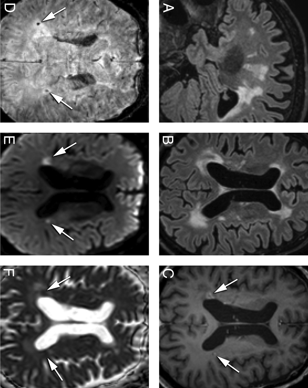 AJNR：视网膜血管病伴白质脑病和多系统损害的神经影像学表现