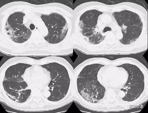 【每日一例413】慢性嗜酸细胞性肺炎CT病例图片影像诊断分析