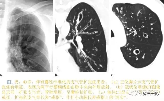 16种支气管扩张相关常见及不常见疾病的机制及影像特征
