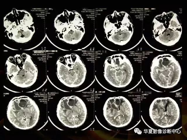 【影像基础】脑脓肿分期和CT表现