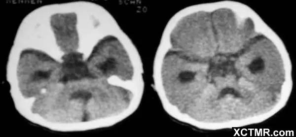 【PHILIPS每日一例】无脑回畸形伴胼胝体发育不良CT病例图片影像诊断