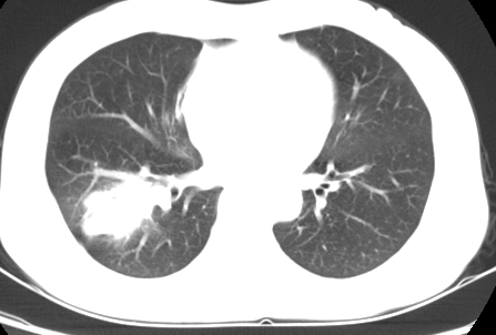 支气管树<font color="red">爬行</font>征：肺内结核性肉芽肿的特征性CT征象之一