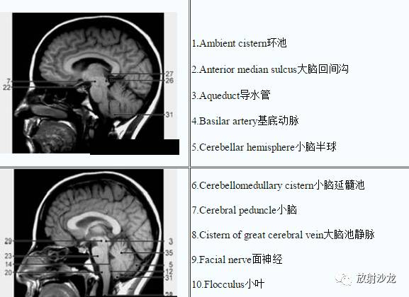颅脑幕下MRI<font color="red">矢</font><font color="red">状</font>及横断解剖中英文对照标识(图文)