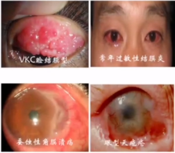 COSD 2022 ：免疫性角膜病的诊断与治疗@MedSci