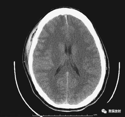 颅脑CT诊断常用的三个窗