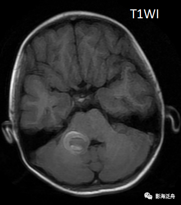 一个颅脑病例，带大家重新认识DWI序列