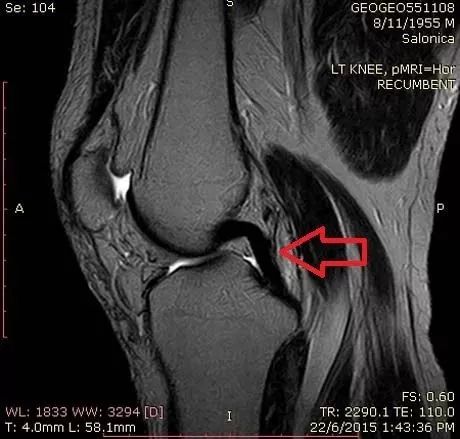 一个膝关节内的“双后交叉韧带征”【YXZX098】