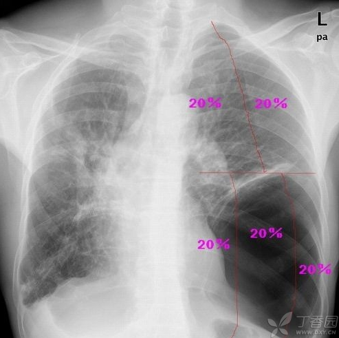 气胸：<font color="red">肺</font>压缩程度的估算（图文详解）