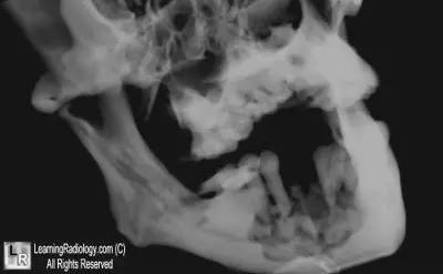  颌骨双磷酸盐相关性骨坏死病例讨论