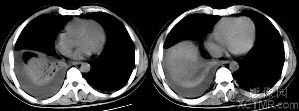 肝脓肿(Liver abscess) <font color="red">CT</font>病例2图片影像诊断分析