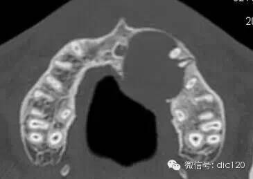 上颌骨含牙囊肿CT病例图片影像诊断分析
