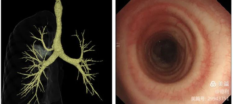 德利专栏丨气管病变的CT影像表现