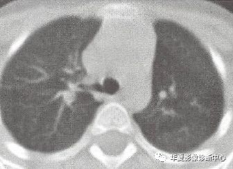 【影像拾遗】两种变异支气管，你会诊断吗？
