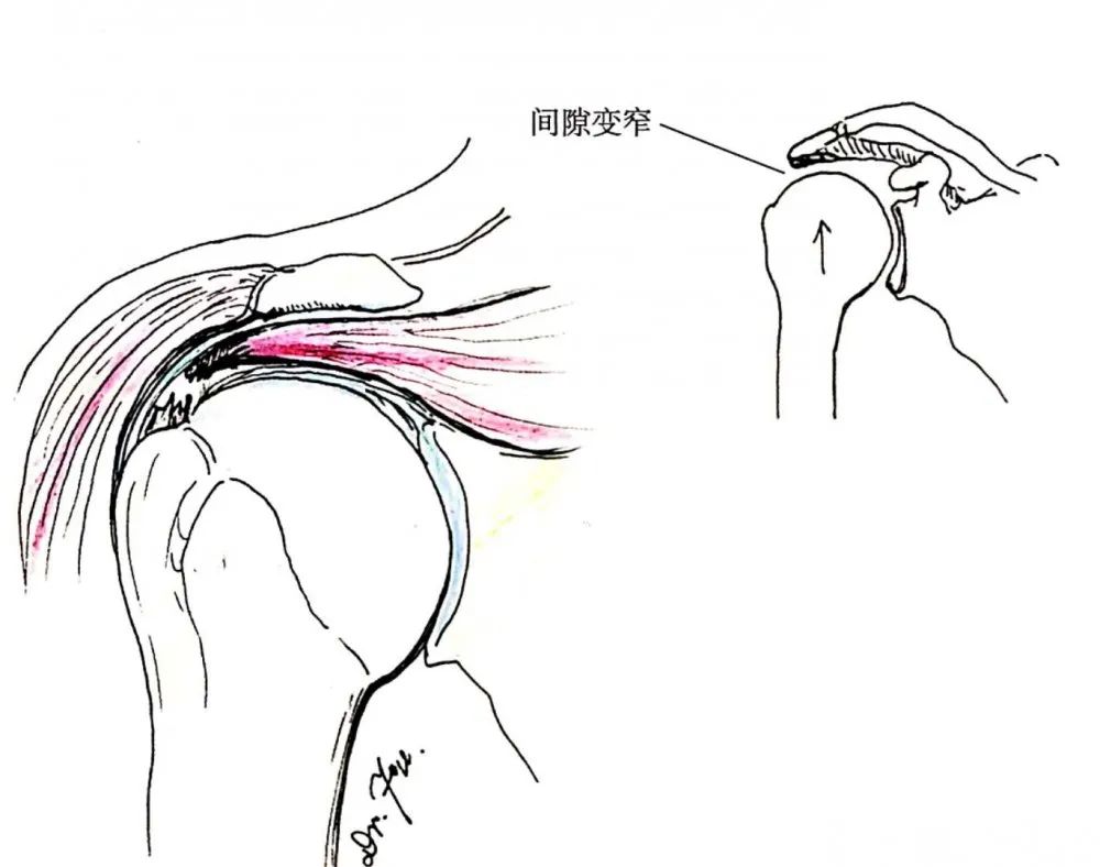 一文掌握｜肩袖损伤的缝线修复技术