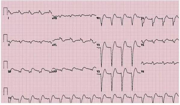 【读图试身手】从1例急性心肌梗死患者的心电图谈开