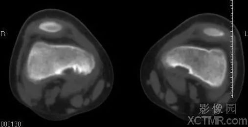 股骨远端纤维性骨皮质缺损X线-CT病例图片影像诊断分析