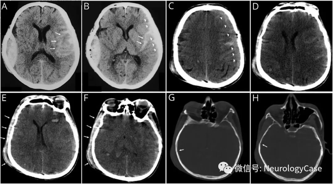 Neurology病例：因对侧<font color="red">硬</font><font color="red">膜</font><font color="red">下</font><font color="red">血肿</font>压迫所致急性单侧硬膜外<font color="red">血肿</font>快速消失
