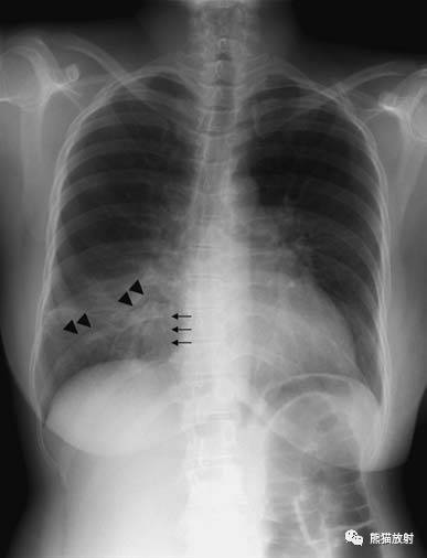 【急诊大作战】肺炎、COPD、肺水肿、心脏扩大、气胸（胸部X线平片）