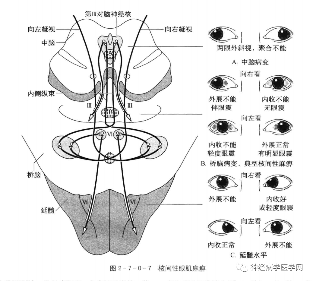 六、眼球运动神经核对眼外肌的支配-眼耳鼻喉-医学