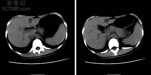 【每日一例】肝左叶假肿瘤表现（镰旁假病灶）CT病例图片影像诊断分析