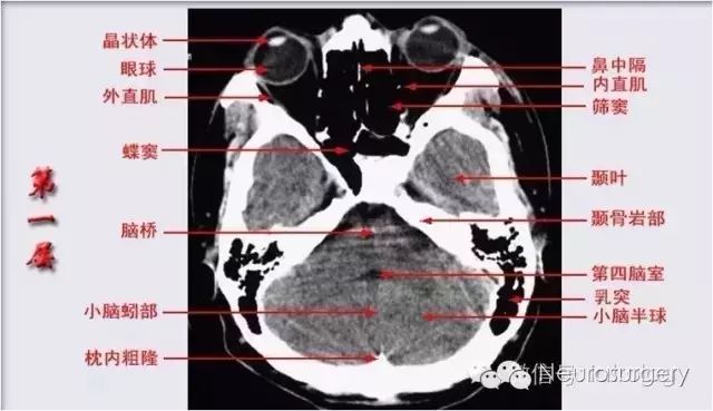 颅脑CT解剖口诀及彩色解剖图