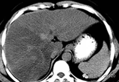 脂肪肝--CT病例图片影像诊断分析