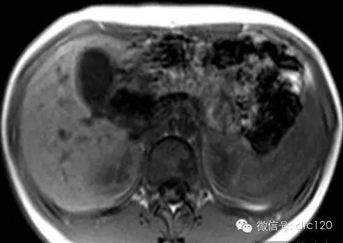 先天性胆管囊肿--MRI-MRCP病例图片影像