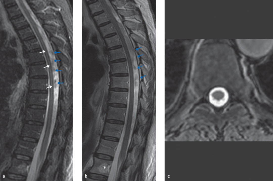 脊柱MRI成像中常见伪影 (artifacts)