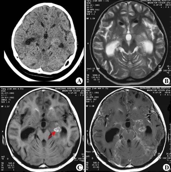隐球菌性脑膜炎1-CT病例影像诊断