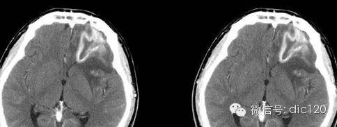 左额叶<font color="red">脑</font>脓肿CT病例图片影像诊断分析