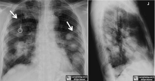 肺癌x光片表现图片