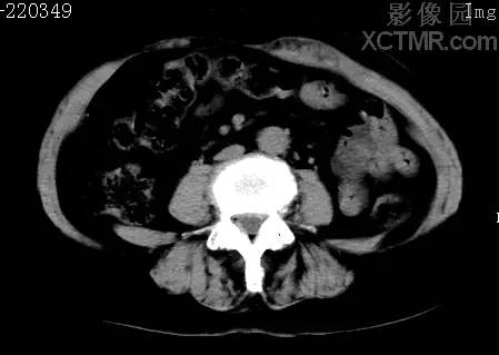 腹直肌韧带样<font color="red">纤维瘤</font>伴出血CT病例图片影像诊断分析