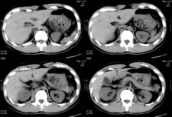 右侧<font color="red">腹膜</font>后血肿(Retroperitoneal hematoma)CT病例