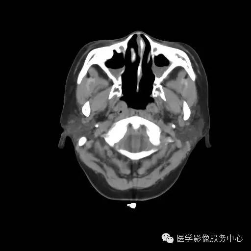 卡塔格内综合征（支气管扩张症、副鼻窦炎和右位心三联征）CT表现