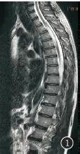 【每日一例】髓内神经鞘瘤的MRI诊断1例