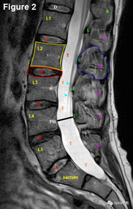 医影基础 | 腰椎MRI阅片细节
