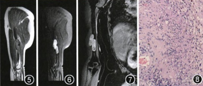 肱骨原发性神经鞘瘤一例
