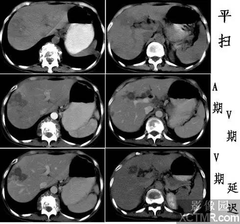 肝脏结核(Hepatic tuberculosis)CT病例图